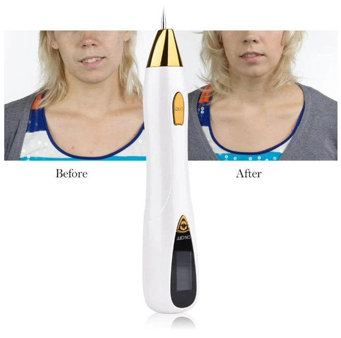 Skin Care Laser Mole, Tattoo Freckle, Wart Corns Dark Spot Removal Pen LCD - Pink